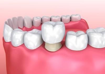 dental crown on lower jaw | dental crown lakeville mn