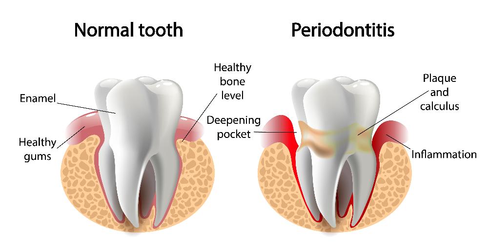 gum disease graph | cosmetic dentist lakeville mn