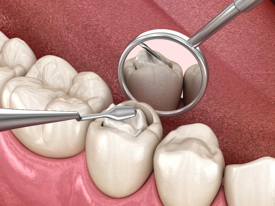 close up of tooth colored filling in tooth | tooth colored fillings lakeville mn
